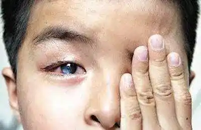 种类非常多,但最终导致我们眼睛致盲的根本就在于我们角膜组织的病变