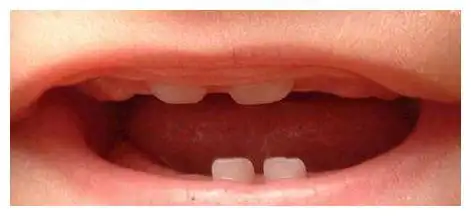 问:宝宝长牙的顺序与时间?|宝宝|牙龈|齿槽_新浪新闻