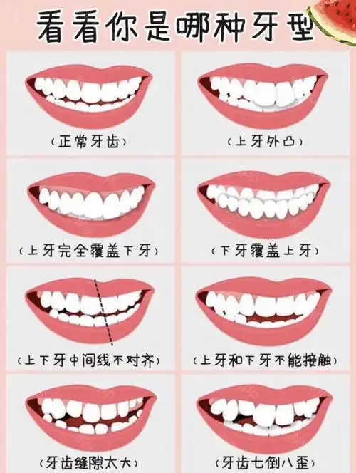 牙齿矫正你需要知道这些各种牙型对照