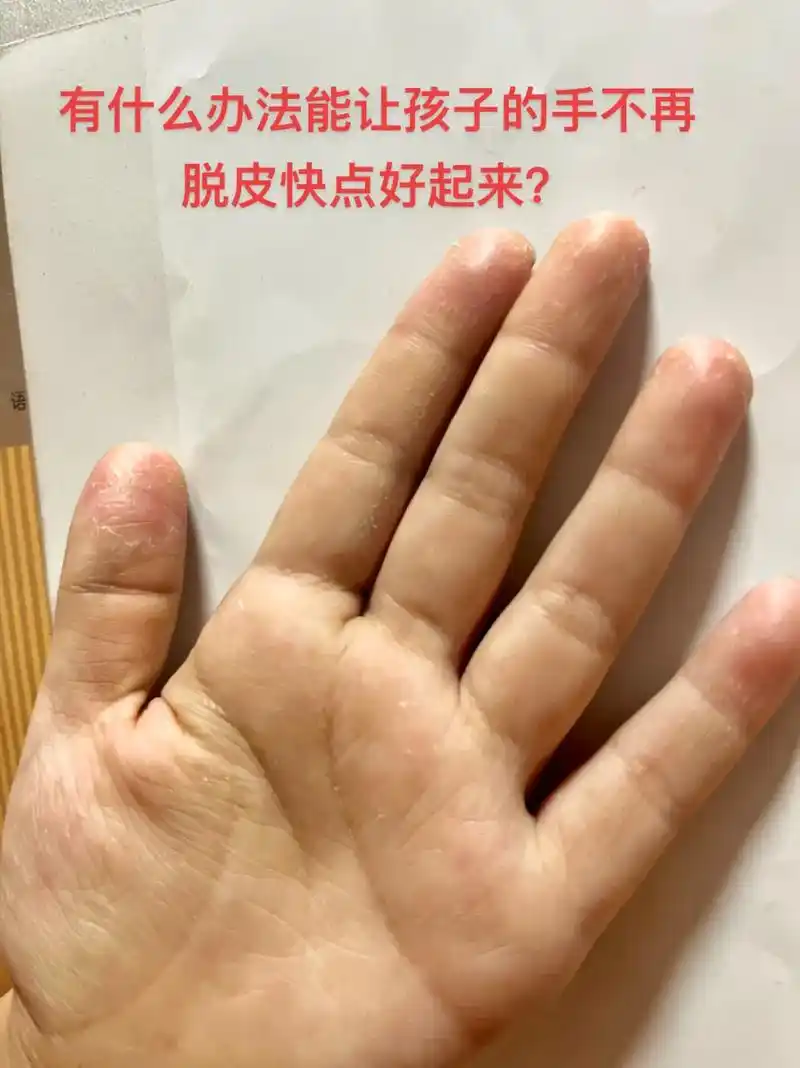 孩子的手不疼不痒,这次脱皮有半个多月了也不见好,反而越来越严 - 抖