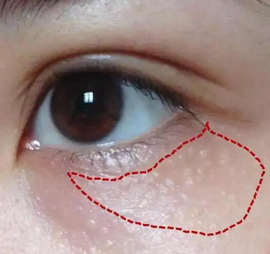 眼部长脂肪粒很难看改变这几个习惯能够快速去除脂肪粒