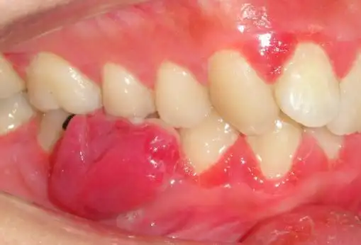 怀孕3个月牙龈上长出个肉瘤 先手术还是先生宝宝?