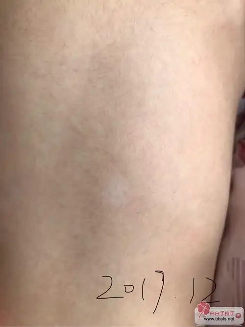 想请各位友友们帮我看一下小孩后背白斑!