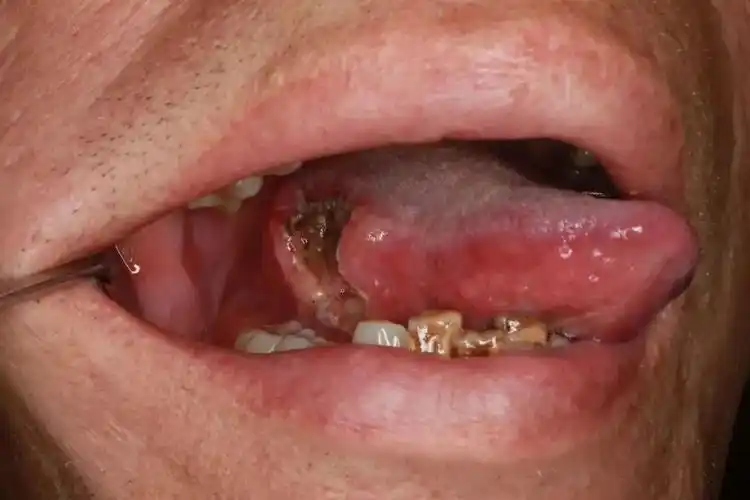 方一鸣带你辨识易被忽视的口腔杀手口腔癌