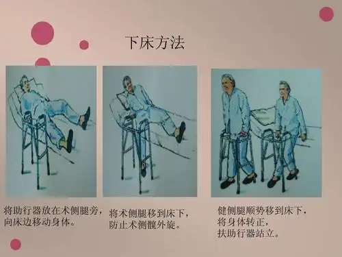 【康复指导】髋关节置换手术后不同时期康复锻炼要点