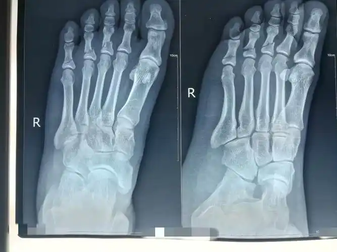 右足第3,4,5趾骨骨折