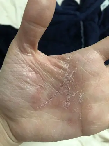 皮肤脱皮,特别是到夏天的时候更严重,冬天会好转