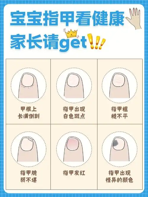宝宝爱咬指甲怎么办宝宝指甲看健康
