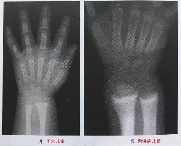 看一眼就知道宝宝得了佝偻病?你是透视眼吗?