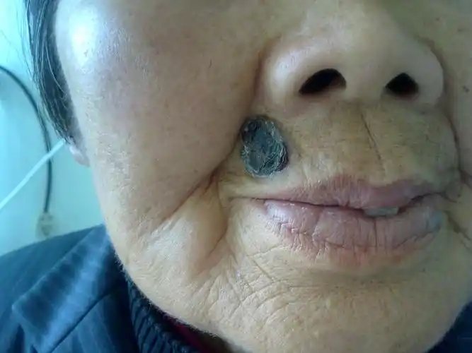 【病例讨论】面部肿物:黑色素瘤? [病例帖]