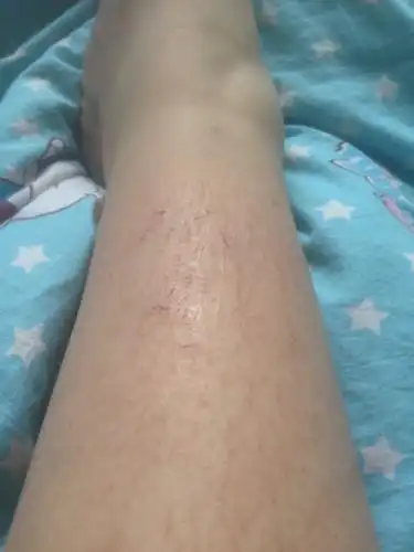 小腿前面像这种裂开一样很难看 ,夏天想穿九分裤都