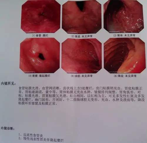 最近做了胃镜检查,结果如下,请问严重么?