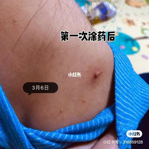 儿童传染性软疣治疗过程_育儿经验_母婴_母婴_育儿经验