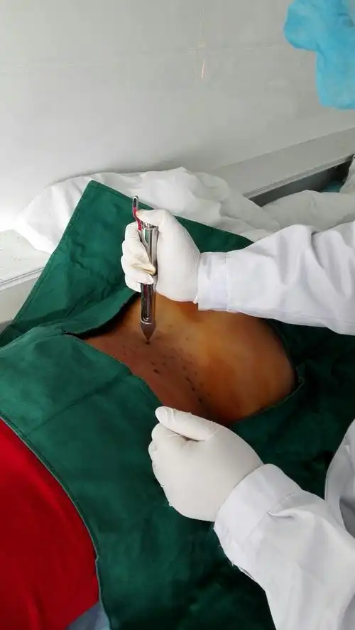 吴忠康复专科医院开展银质针骨骼肌松解术治疗腰椎间盘突出症取得了