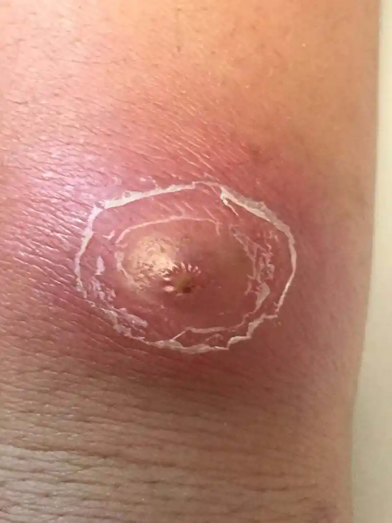 身上长的疖子别大意,当心"小疖"成"大劫",医生:有这些危害