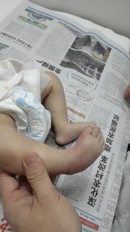 先天性马蹄内翻足的石膏矫形治疗 - 好大夫在线