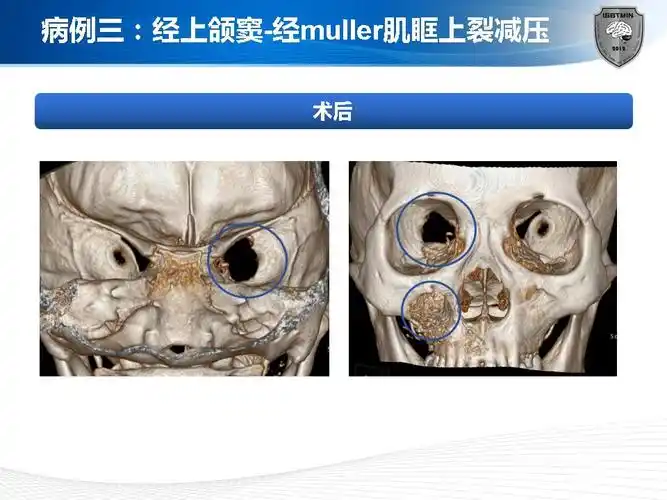 眶上裂综合症的微创手术治疗 - 好大夫在线