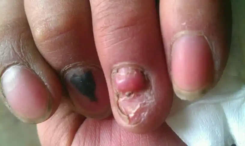 答: 病情分析: 您好,如果您外伤后,甲床和甲根没有严重的损伤的话