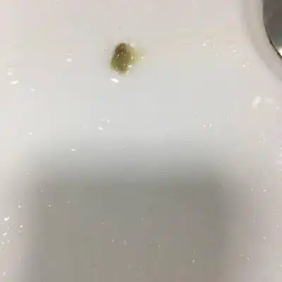 从知道怀孕后,嗓子就开始不舒服,吐出来的就是黑色粘液的痰,怎麼回事