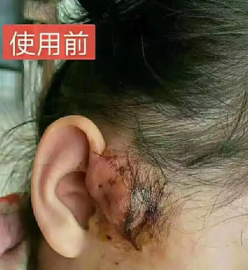 不可以  耳前瘘管多是由于先天发育 - 抖音