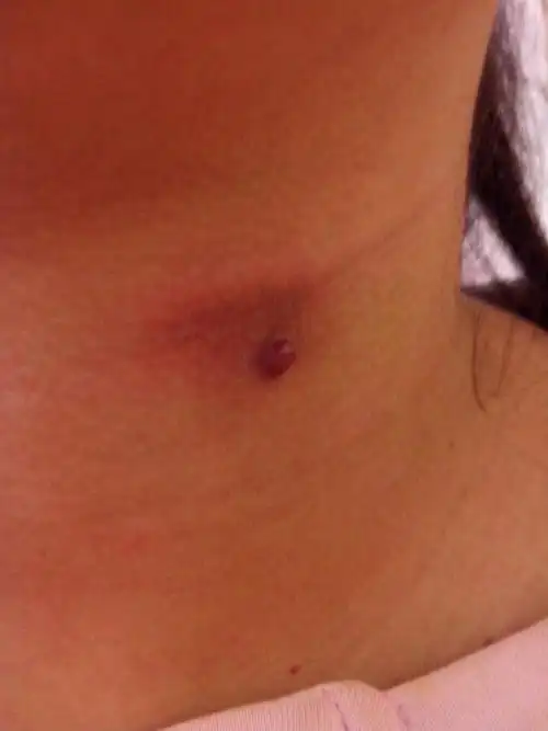 脖子长了一个类似于血泡的疙瘩不疼不痒的弄破后有血流出但