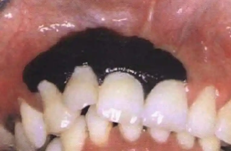 口腔内壁黑色素瘤图片