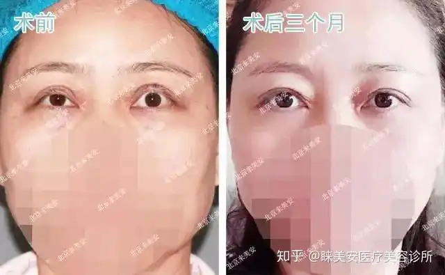 双眼皮修复外翻案例集锦