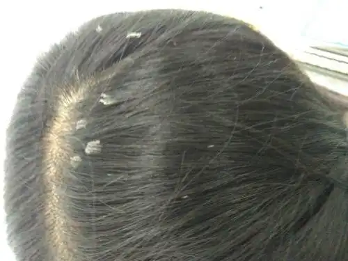 大块头皮屑照片