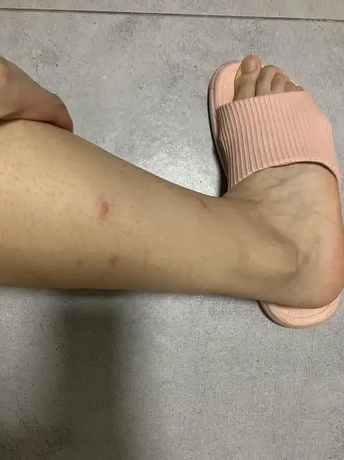 这是什么虫?咬人这么毒