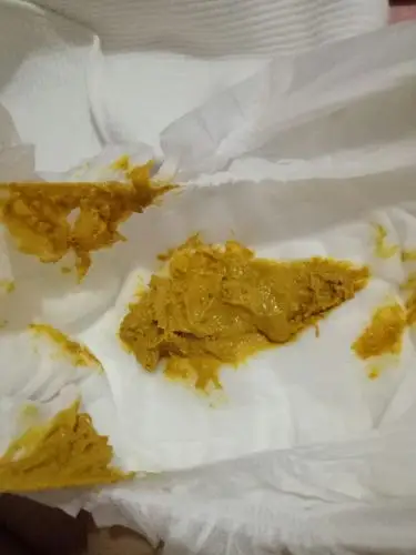 你们帮我看下宝宝拉的大便正常吗