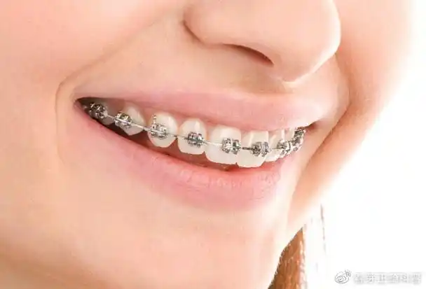 牙套汇总大全,6哪种牙套更适合你?