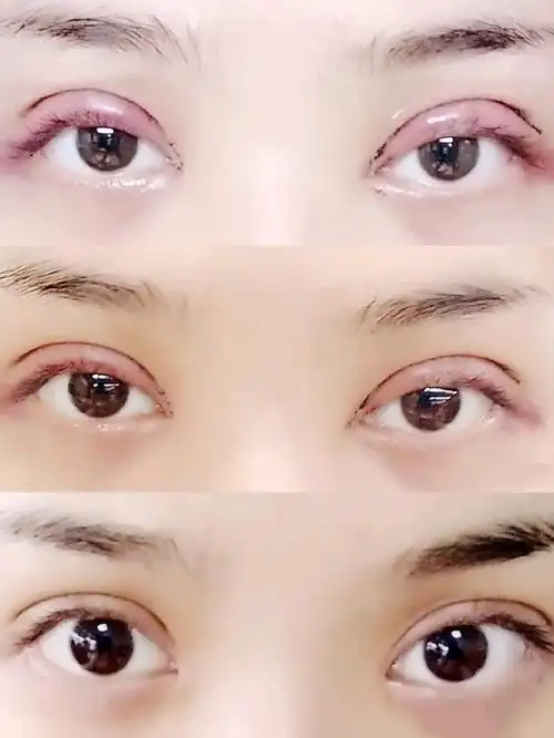 我做的是全切双眼皮和开内外眼角,我选择全切的话主要就是埋线的话