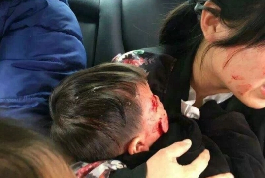 在合肥一小区,恶狗把孩子咬成这样,场面极其吓人