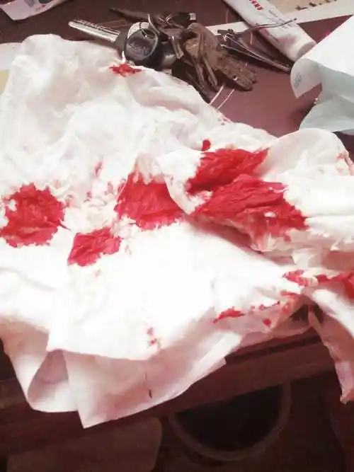 同床后出血图片 如何避免同床后生殖器损伤