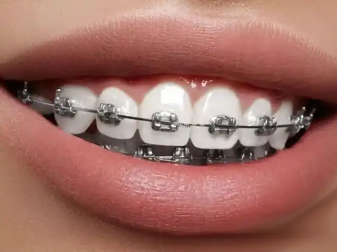 不锈钢牙套牙的价格多少?你想了解的都在这!_ip138媒体号