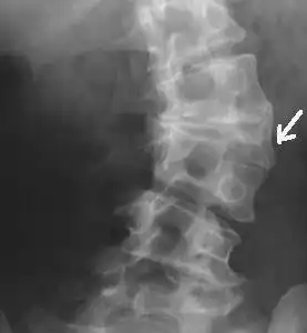 骶椎隐形脊柱裂是怎么回事?有没有图片共享一下?