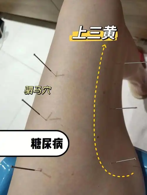 针话第33集糖尿病患者可以这样做