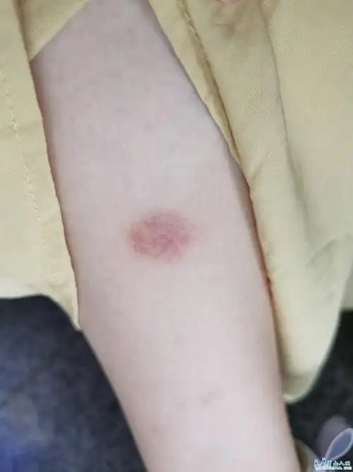 我这是什么体质?一被蚊子咬就是这种样子,是对乡坝头的蚊子过敏吗?