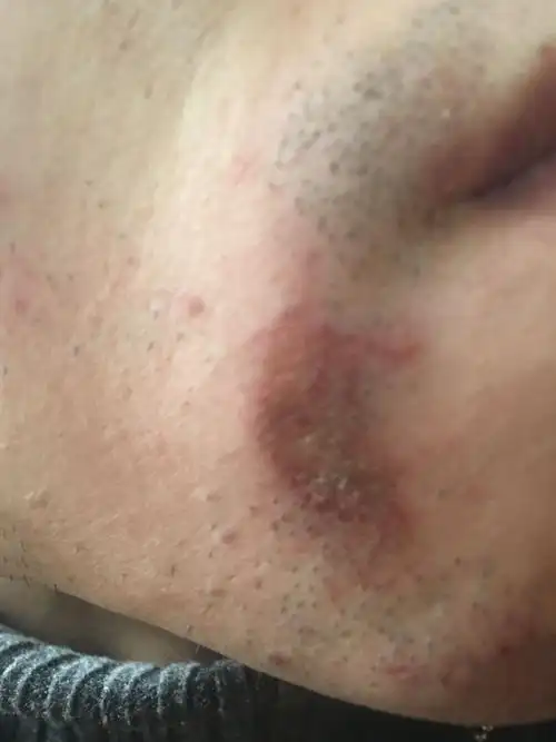 我的面被脱毛膏烧伤多久能好