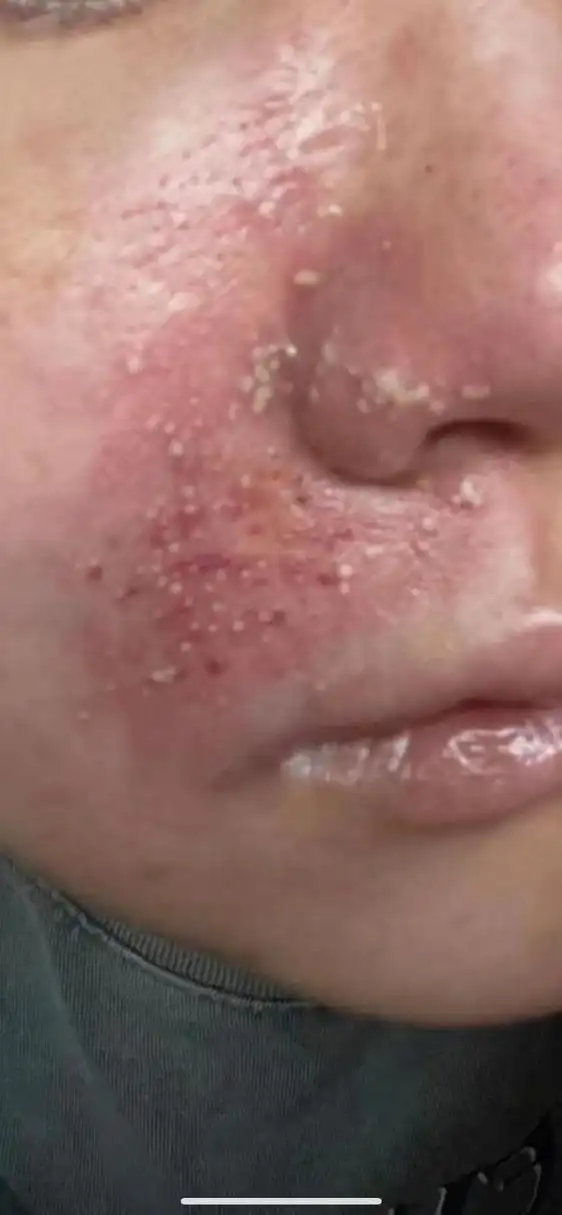 今天是第四天,皮肤发暗,色黑,毛孔出脓