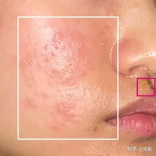 过敏性体质哮喘过敏性鼻炎荨麻疹各类湿疹抗病经验分享现状