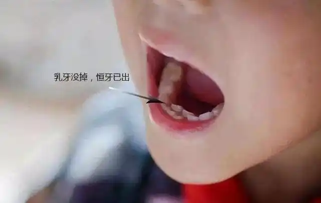 还有牙齿咬合错位,多生牙,恒牙胚缺失等等……掉了长双排牙的,这叫