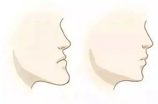 月亮脸就是下巴极其突出,突到即使长了个高鼻梁,从侧面看过去脸中间