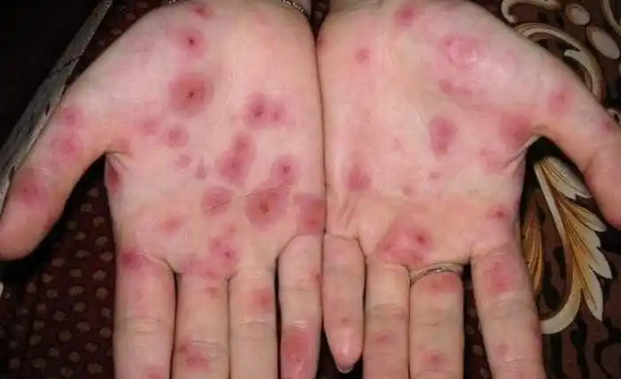 若梅毒"潜藏"在体内,身体可能会发出4个"预警信号",别大意_传播_症状