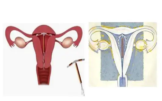 可能是一颗定时炸弹 写美篇 节育环是按照育龄期妇女正常子宫腔的形态