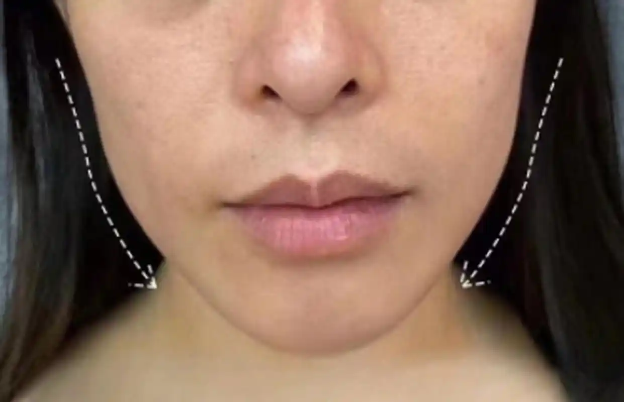 常常伴随颧弓外扩,唇部突出,面部轮廓不流畅等,这就是面颊凹陷