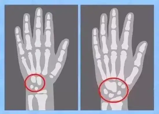 由于过早发育许多孩子的骨骺线会提前闭合,生长空间要比正常发育的