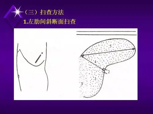 脾脏超声诊断