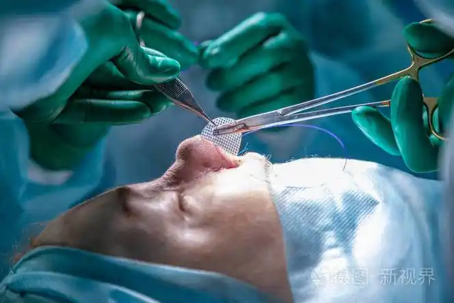 外科医生和他的助手执行整容手术在医院手术室的鼻子上.鼻整形, 隆胸.