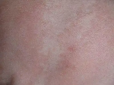 引起贫血痣是因为什么原因